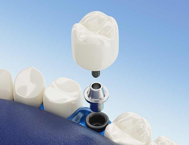 Dental Implants Are Even More Advanced, Thanks To These Other Technologies
