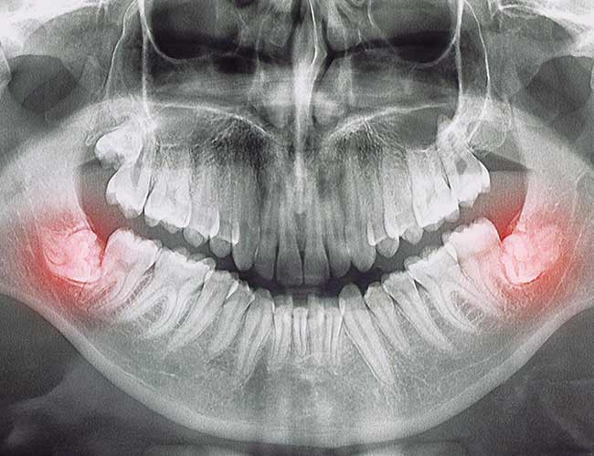 Although Rare, This Condition Could Destroy a Tooth
