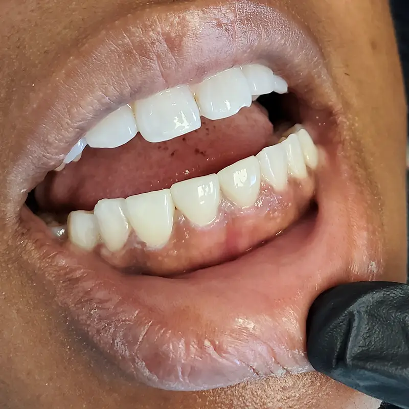 After Veneers