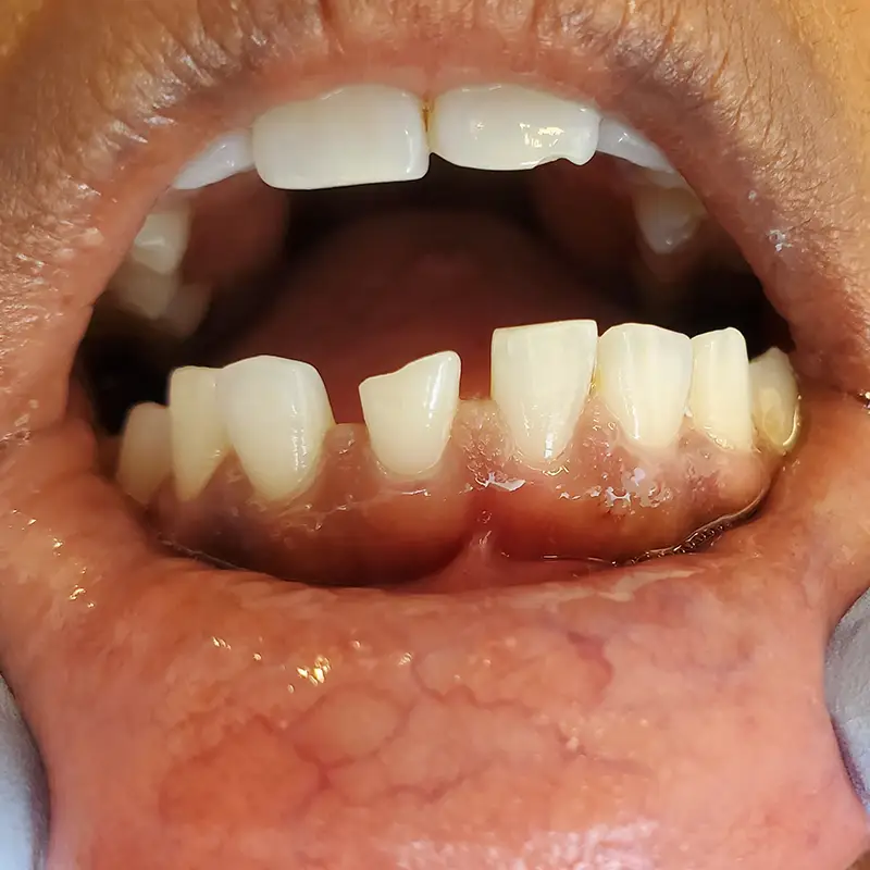 Before Veneers